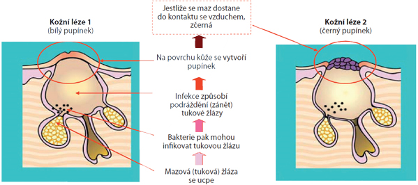 Rozdíl mezi mechanismem vzniku bílého či černého pupínku