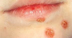 Impetigo