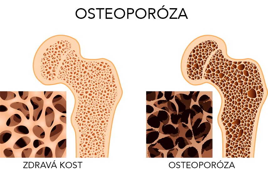 Osteoporóza