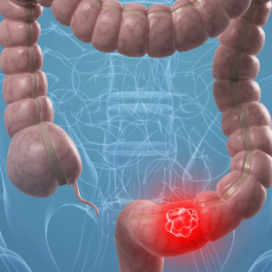 Rakovina tlustého střeva, její příznaky a léčba